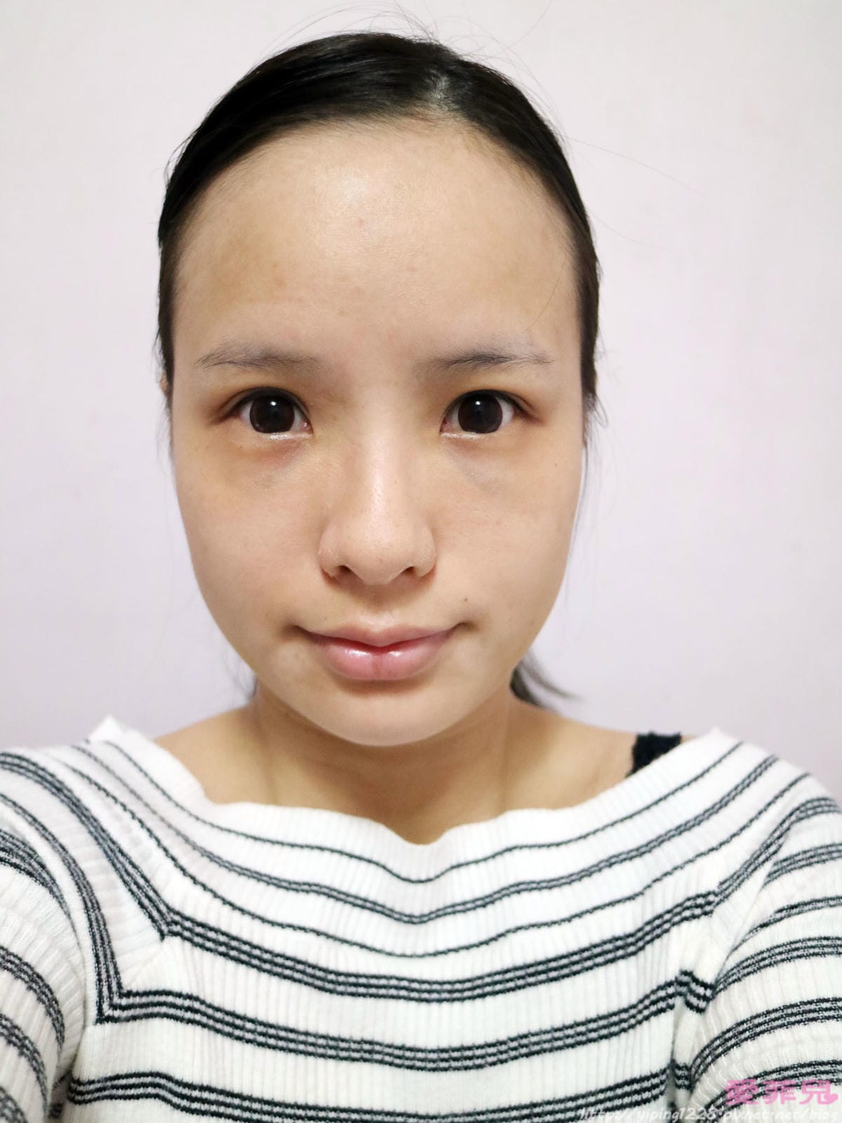 豐唇/補淚溝/美麗爾 豐唇/補淚溝/美麗爾