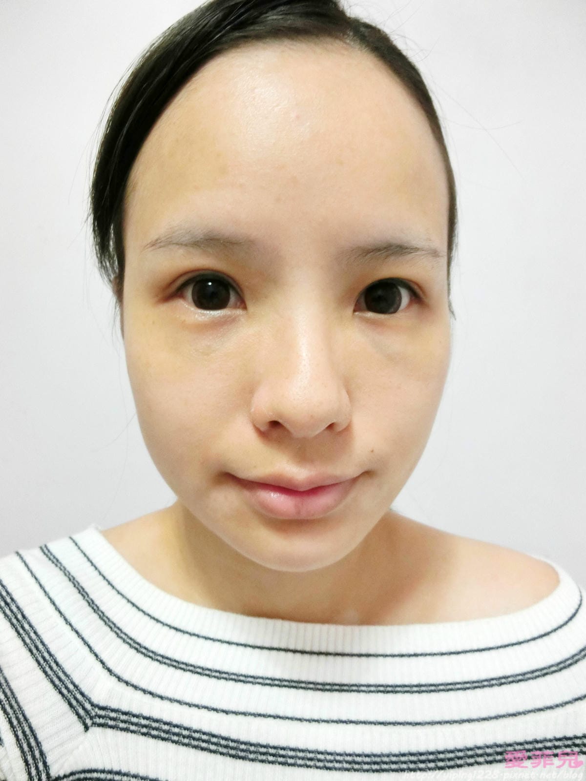 兩禮拜後變成自然的錐子臉 錐子臉-醫美診所推薦