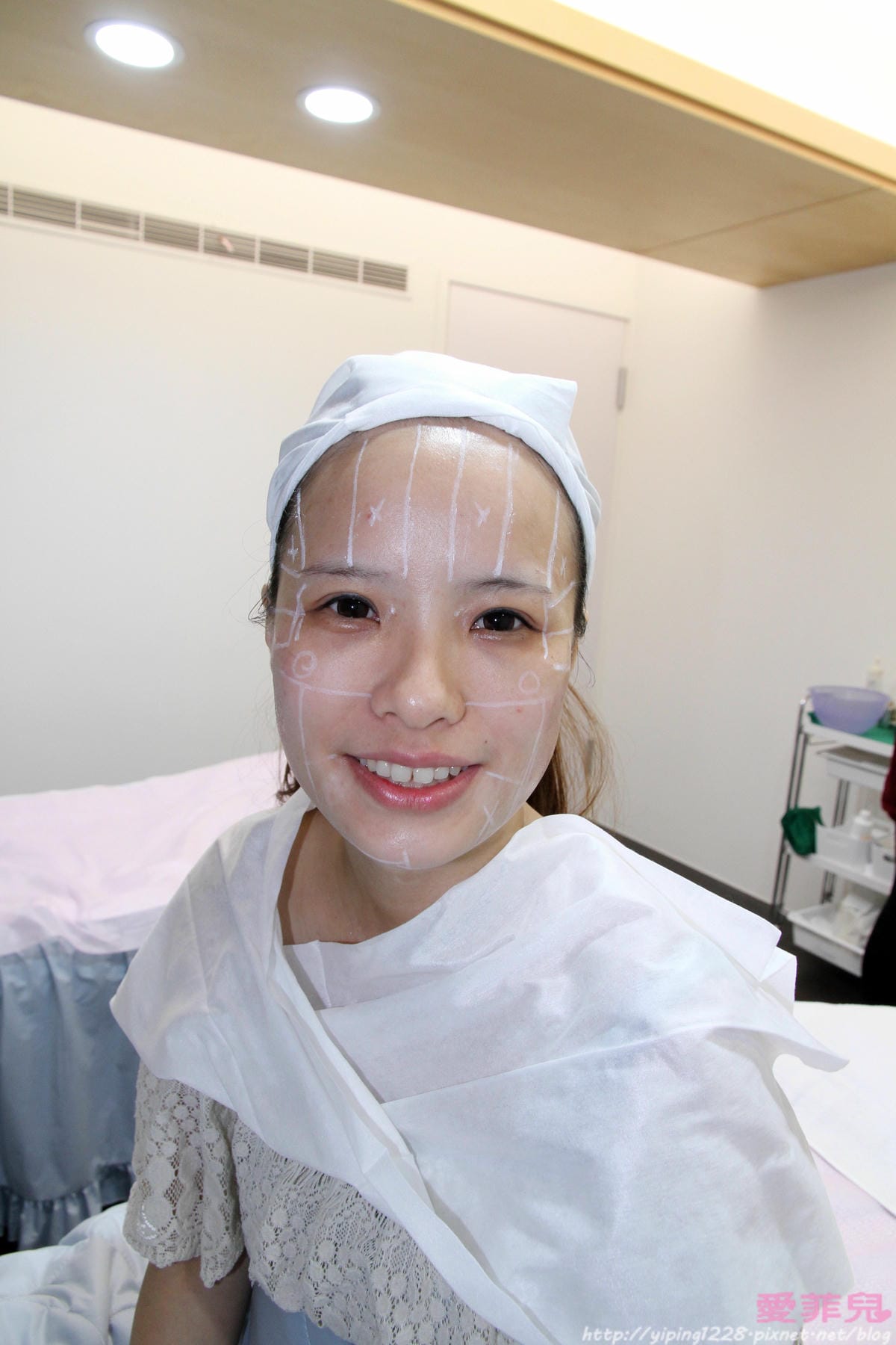 右臉施打完畢後拉提感明顯 明顯拉提感-醫美診所推薦