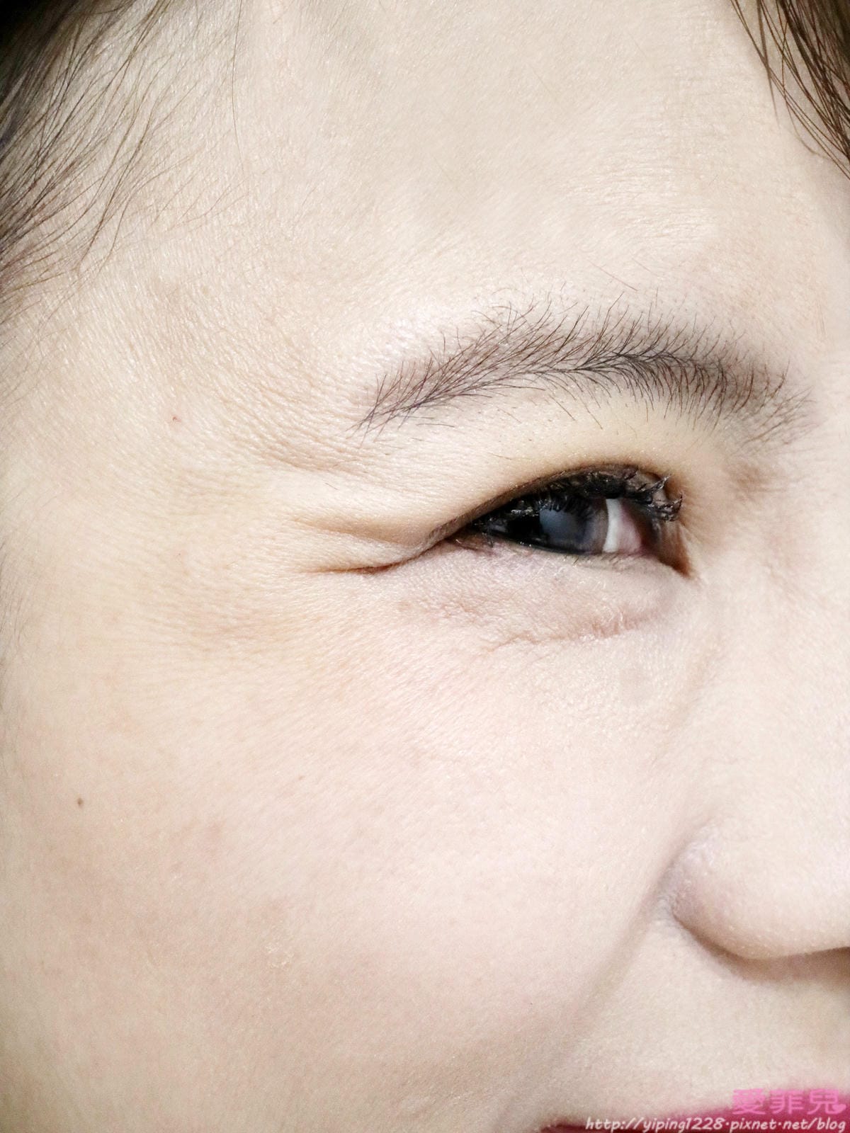 中山區詠麗醫美珍所/肉毒桿菌
