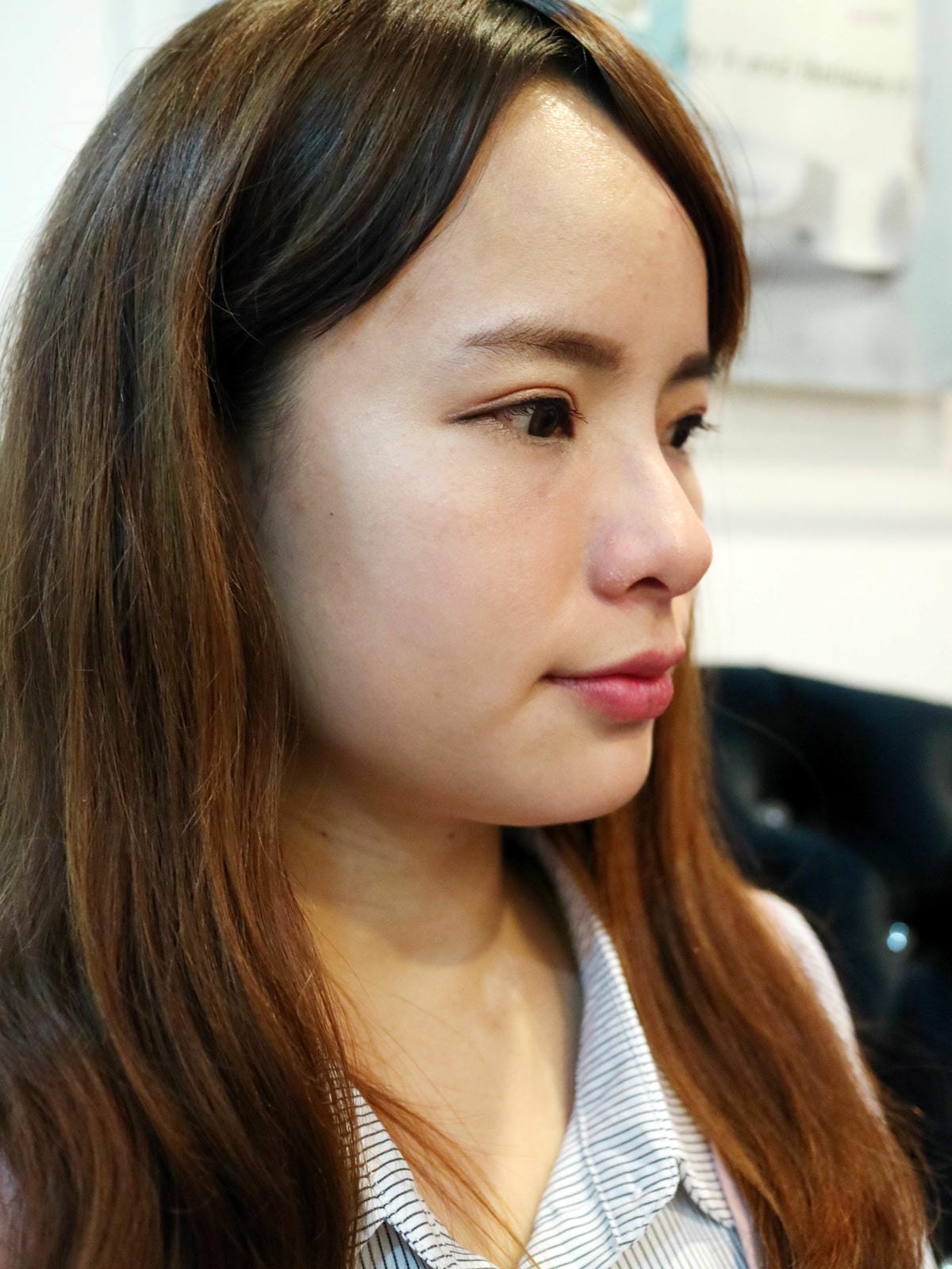 填補Princess公主玻尿酸+FONTONA4D美塑拉提(口內雷射)→讓雙下巴不再出來見人！BY~忠孝雅美姬時尚診所