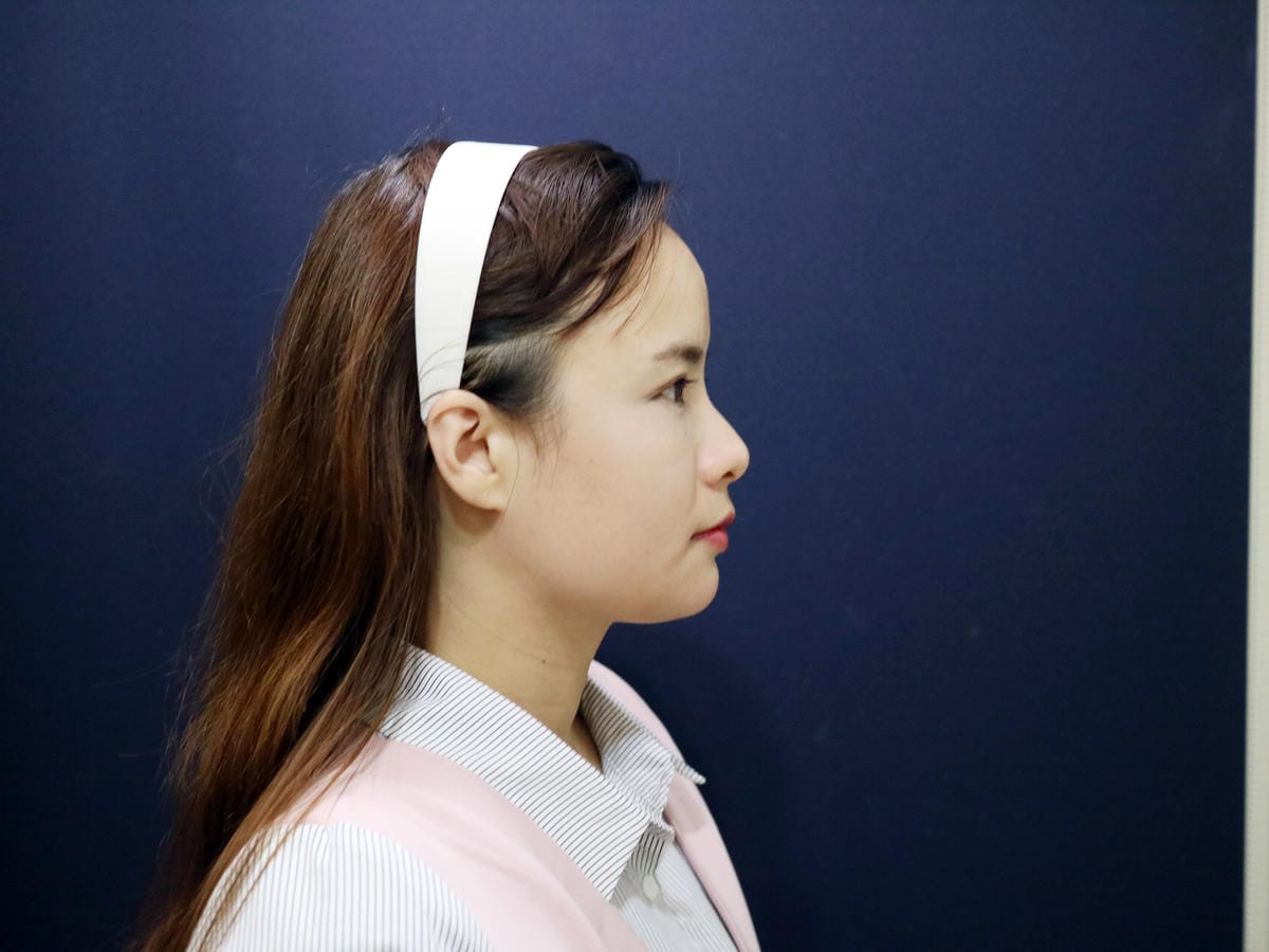填補Princess公主玻尿酸+FONTONA4D美塑拉提(口內雷射)→讓雙下巴不再出來見人！BY~忠孝雅美姬時尚診所