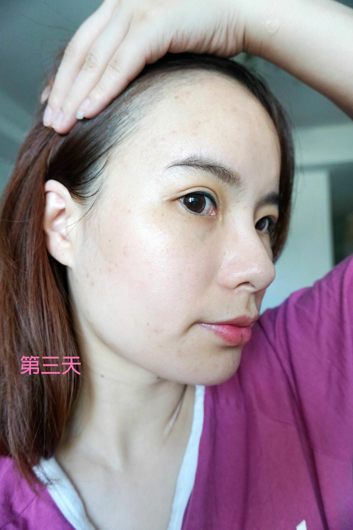 佳醫美人/皮秒雷射 佳醫美人/皮秒雷射