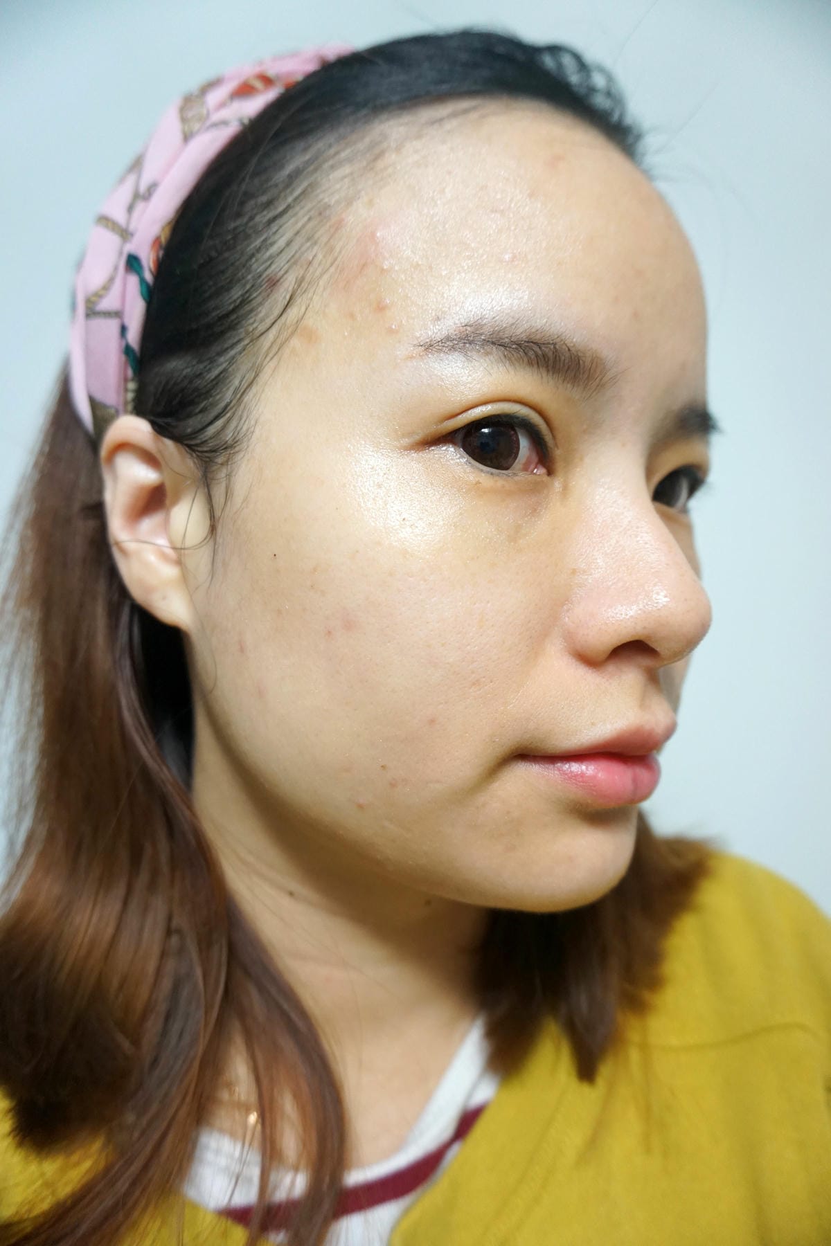 尚緹診所/M22彩衝光/肉毒桿菌/改善暗沉/小臉/雷射