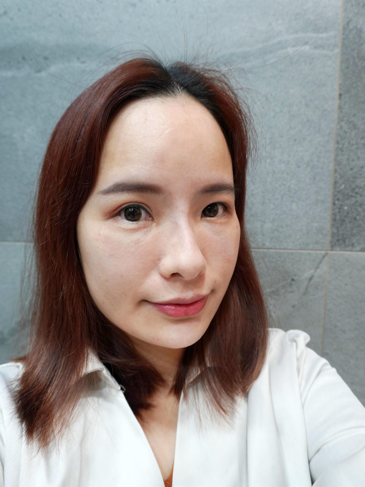 樂菲時尚診所/動態玻尿酸/補淚溝/新莊醫美診所推薦 樂菲時尚診所/動態玻尿酸/補淚溝/新莊醫美診所推薦