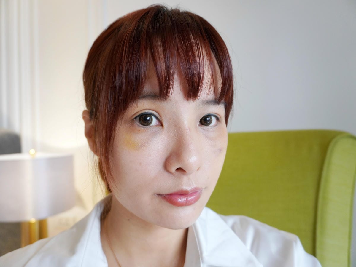 樂菲時尚診所/動態玻尿酸/補淚溝/新莊醫美診所推薦 樂菲時尚診所/動態玻尿酸/補淚溝/新莊醫美診所推薦