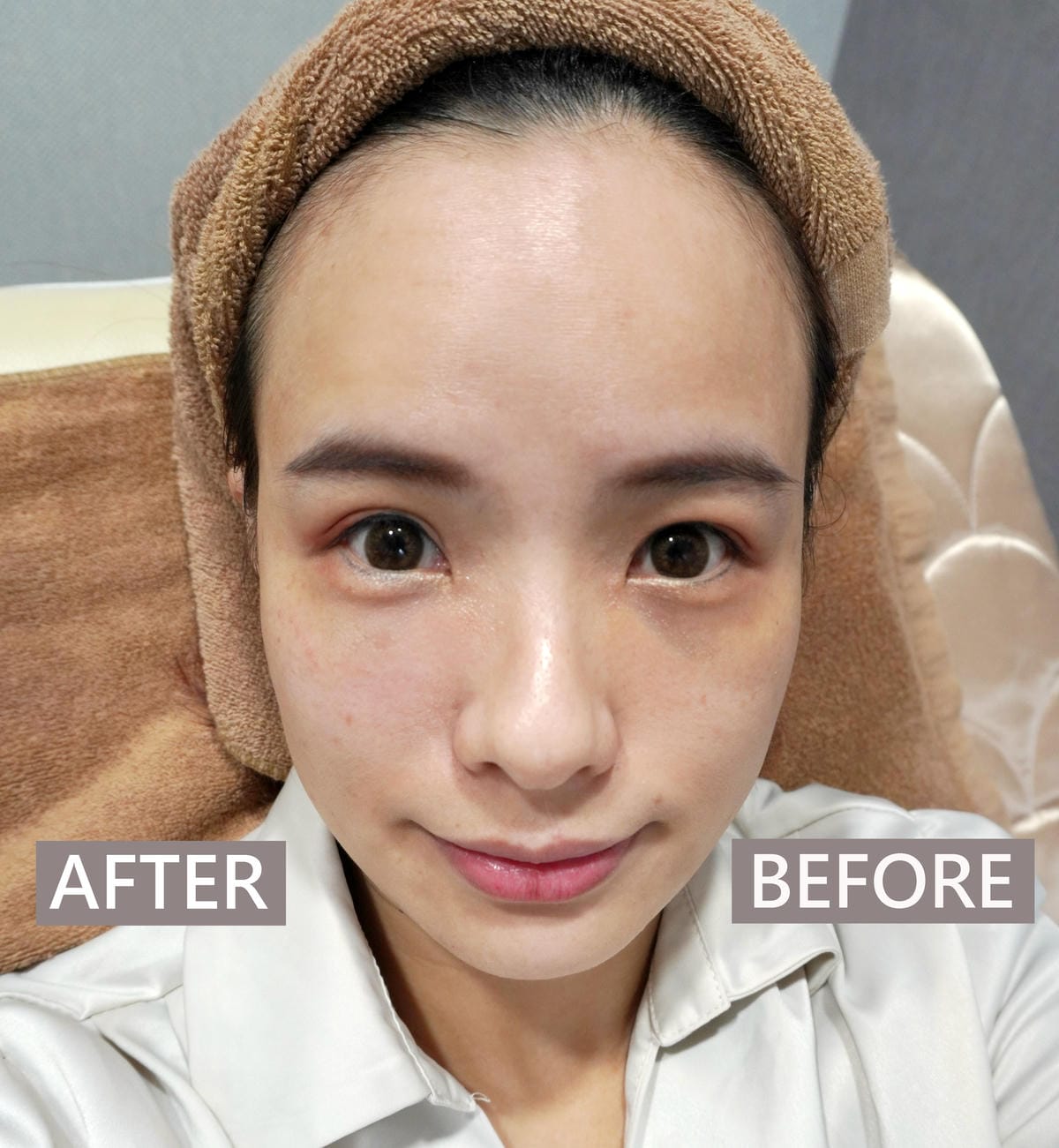 樂菲時尚診所/動態玻尿酸/補淚溝/新莊醫美診所推薦 樂菲時尚診所/動態玻尿酸/補淚溝/新莊醫美診所推薦