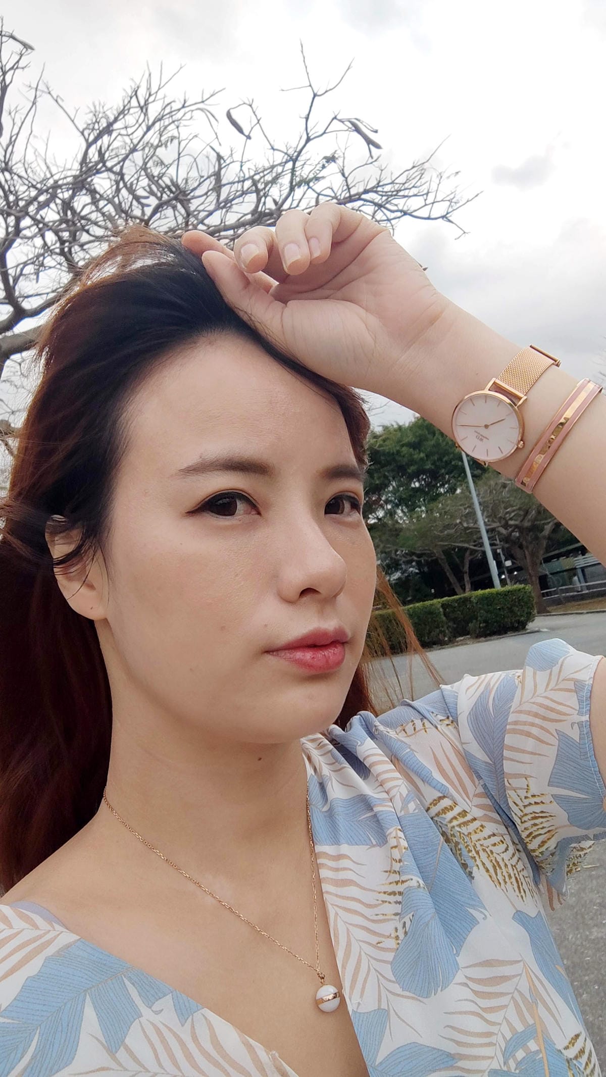 皙妍診所-V塑拉提(VSORB-V塑線)蛇牙線-臉部雕塑-消除雙下巴 皙妍診所-V塑拉提(VSORB-V塑線)蛇牙線-臉部雕塑-消除雙下巴