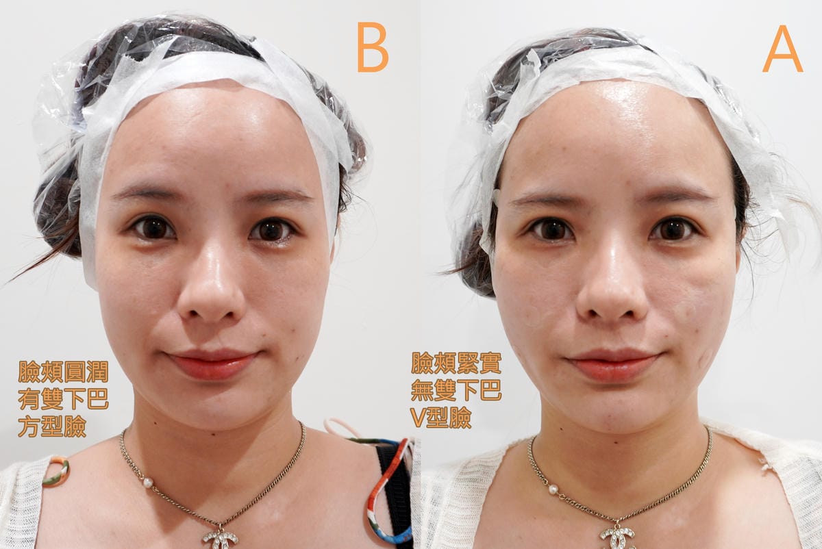 皙妍診所-V塑拉提(VSORB-V塑線)蛇牙線-臉部雕塑-消除雙下巴 皙妍診所-V塑拉提(VSORB-V塑線)蛇牙線-臉部雕塑-消除雙下巴